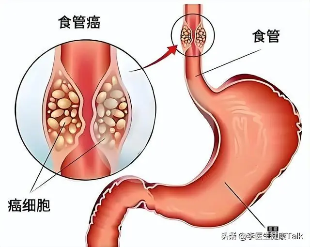 浙江大学分析100名胃癌患者，惊讶发现:患胃癌的人，有7大共性