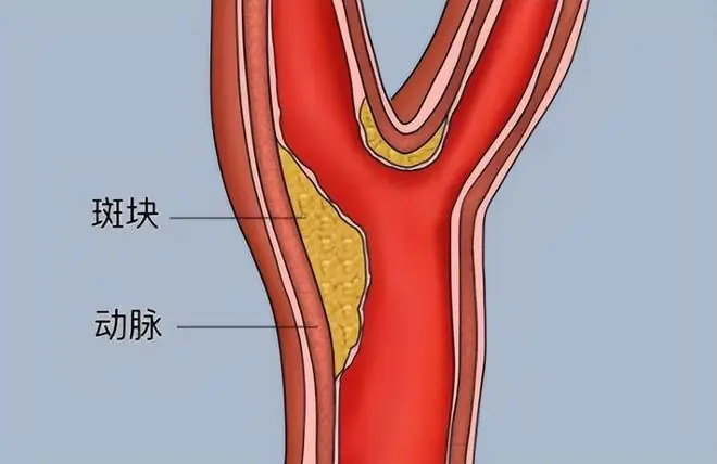 医生告诫:一旦确诊颈动脉斑块,6种食物必须戒掉,避免斑块增大